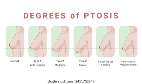 Degrees of ptosis female breast sagging normal and medical problem stages scheme vector flat illustration. Woman anatomy chest muscle skin bust condition educational medicine diagram body health: stockvector