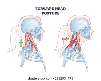 Forward head posture compared with healthy neck position outline diagram. Educational scheme with turtle neck condition and muscular system vector illustration. Anatomical spine problem explanation. Immagine vettoriale stock