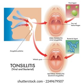 Medical illustration of the symptoms of viral and bacterial tonsillitis, also called viral amygdalitis and bacterial amygdalitis, with the pathogens that cause the infection. Arkistovektorikuva