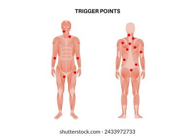 Myofascial trigger points medical poster. MTrPs concept. Hyperirritable spots in the skeletal muscle knots in male silhouette. Red points in sensitive areas on the human body flat vector illustration Stock-vektor
