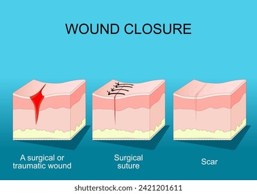Wound healing. Skin before and after Wound Closure. From surgical or traumatic wound to suture and scar. A fibrous tissue replaces normal skin after an injury healing process. 庫存向量圖