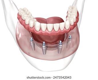 Dental prosthesis based on 4 implants. Dental 3D illustration Stockillustration