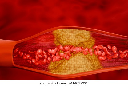 Hyperlipidemia or arteriosclerosis. Blocked artery concept and human blood vessel as a disease with cholesterol fat buildup clogging. Clogged arteries, Cholesterol plaque in the artery. 3D Rendering Stock Ilustrace