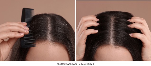Woman showing hair before and after dandruff treatment on brown background, collage, fotografie de stoc