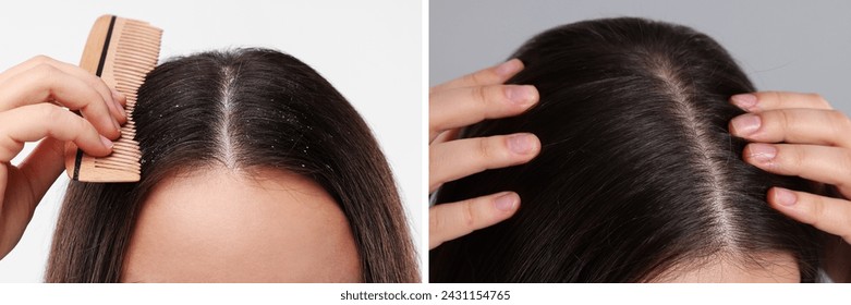 Woman showing hair before and after dandruff treatment on color backgrounds, collage, fotografie de stoc