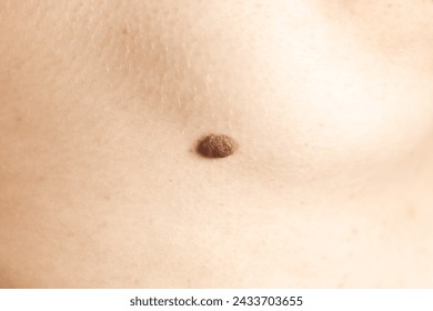 Big birthmark near the woman's breast. Dermatology, health care. Medical treatment. Stockfotó