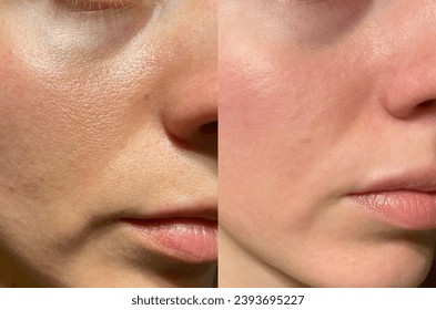 Big pores and small pores. Woman face. Before and after Stockfotó