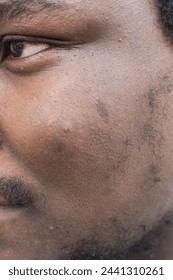 Brown skin with dark spots, hyperpigmentation on brown skin, african american man with skin blemishes, imperfect skin Stockfotó