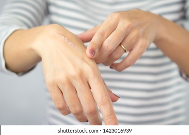 接写：女性の手の1度熱傷の跡。皮膚の表皮最外層の創傷損傷。治癒、除去、治療、台所での事故、傷跡、熱傷、創傷治癒、修復の写真素材