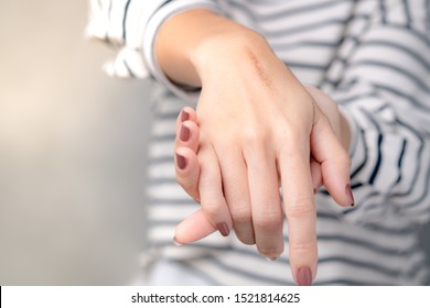 Close up: Hands of a woman with first degree heat burn scar about a months after injured. The wound damage on epidermis outermost layer of skin and now it's in healing process, Scar fading remedies.の写真素材