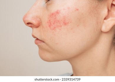 closeup profile of young dark-haired Caucasian woman suffering from the skin chronic disease rosacea on her face in the acute stage. Pink acne. Dermatological problems.isolated on a beige background Stockfotó
