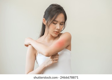 Dermatology asian young woman, girl allergy, allergic reaction from atopic, insect bites on her arm, hand in scratching itchy, itch red spot or rash of skin. Healthcare, treatment of beauty. Stockfotó