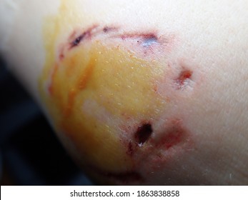 ヨウ素デス感染の手に巻かれた犬の咬傷の詳細の写真素材