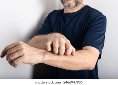 Middle-aged man scratching his forearm. Skin disease. Dermatological care Stockfotó
