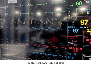 Patient monitor screen showing waveforms of patient vital sighs like ecg, heart rate, SpO2 स्टॉक फ़ोटो