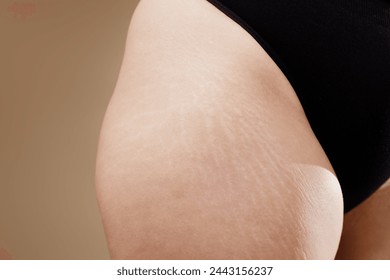 Stretch marks on female legs. A woman's fat cellulite and a stretch mark on her leg. Cellulite. Close up human Skin natural stretch marks Texture. Stretch mark woman belly Stockfotó