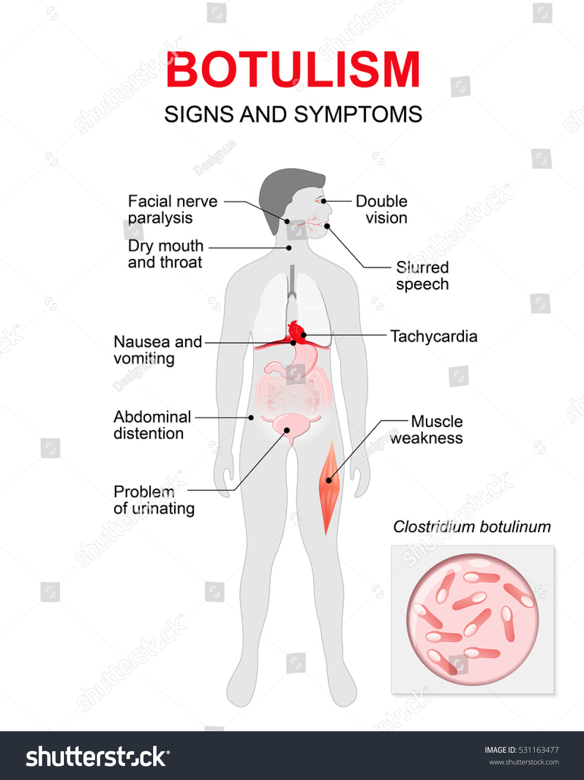 Botulism is a fatal illness caused by a toxin, produced by the bacterium. Signs and symptoms. Human silhouette with highlighted internal organs.