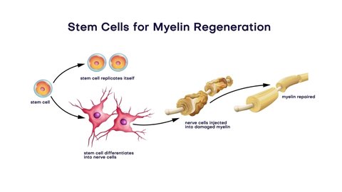 Stem Cells for Myelin Regeneration stem cell
stem cell replicates itself
stem cell differentiates
into nerve cells
nerve cells injected
into damaged myelin
myelin repaired., videoclip de stoc
