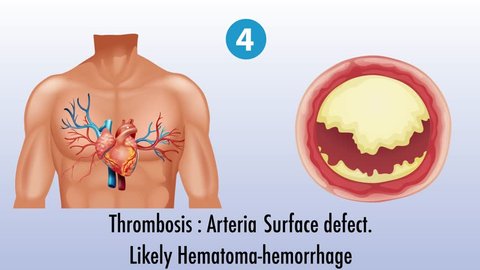 Atherosclerosis stages, Plaque formation in blood vessel. Stock-video