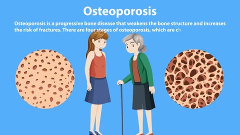 Stages and Progression of Osteoporosis Animation Video stock
