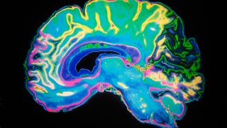 An MRI scan of the brain: weak spots in its blood vessels can leak or rupture
