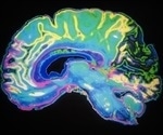 Self-reported memory problems and partner confirmation may signal tau buildup in the brain
