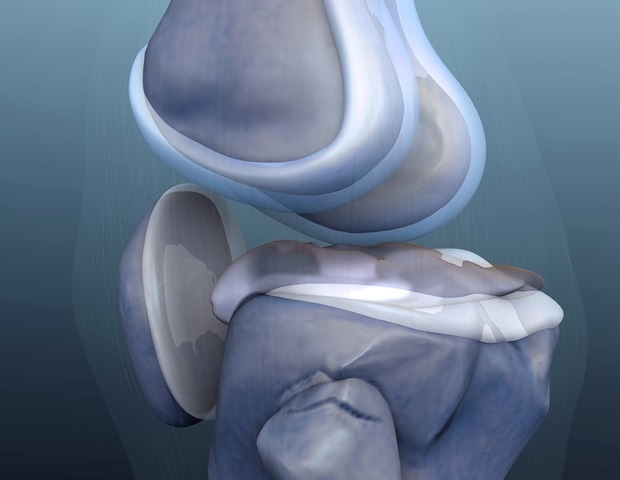 Synthetic cartilage plugs may help heal osteochondral defects and avoid total knee replacements