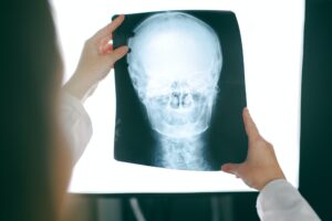 internal injury- types of car accident injuries-Woodstock car accident attorneys- Hagood Injury Law