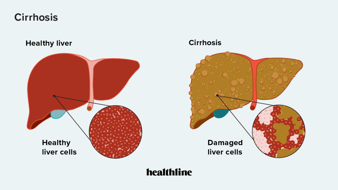 A drawing of how a liver with cirrhosis looks like