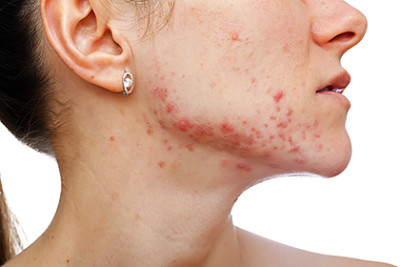 Woman with acne along jaw line