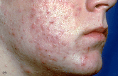 Boy with acne cysts
