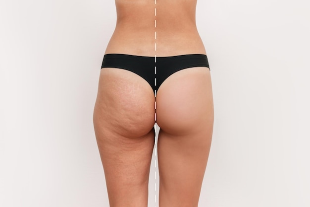 Foto coxas e nádegas de mulher jovem com celulite antes após o tratamento. livrar-se do excesso de peso
