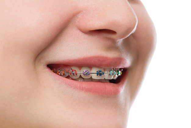 Foto primer plano de frenos multicolores en los dientes hermoso retrato de sonrisa femenina con tratamiento de ortodoncia con frenos selfligating