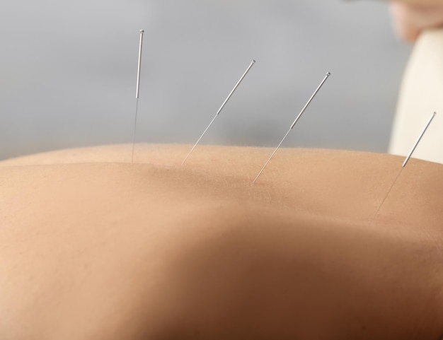 Young man getting acupuncture treatment, closeup