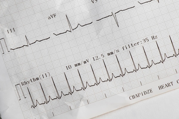 Foto le onde del cardiogramma del cuore battono l'ecg sulla carta