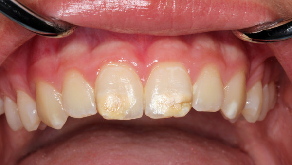 Flecken und Oberflächeneinbrüche des Zahnschmelzes: So äußern sich Kreidezähne.