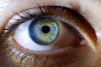 Как проявляет себя кератоконус и какую опасность для зрения представляет, объяснила офтальмолог