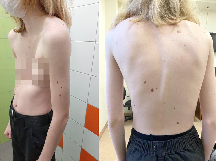 Хирурги Новосибирска спасли 17-летнюю девушку с деформацией груди