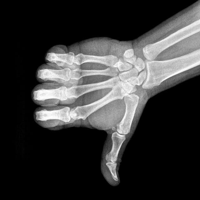 An X-ray of a hand in the shape of a thumbs down. 